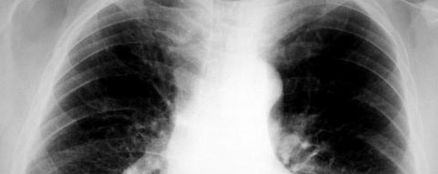 X-ray of lungs. Credit: Clara Natoli / MorgueFile