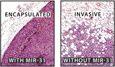 Courtesy / Scott Valastyan/Whitehead Institute
In mice, the loss of microRNA miR-31 allows cancer cells to spread to the lungs more easily than cancer cells with miR-31. The edge of the cancer tumors lacking miR-31 are also less defined than tumors containing cells with higher levels of miR-31