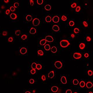 A field of human prostate cancer cells is shown after exposure to laser-activated carbon nanoparticles. The cell membranes have been stained red to assist in visualization. Each of the red circles is a single cell. Credit: Credit: Prerona Chakravarty