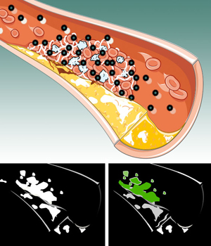 A blood vessel (top) with ruptured atherosclerotic plaque, shown in yellow, is developing a blood clot. The nanoparticles, shown in blue and black, are targeted to a protein in the blood clot called fibrin, shown in light blue. A traditional CT image (bottom left) shows no difference between the blood clot and the calcium in the plaque, making it unclear whether this image shows a clot that should be treated. A spectral CT image (bottom right) sees the bismuth nanoparticles targeted to fibrin in green, differentiating it from calcium, still shown in white, in the plaque.  Wiley-VCH Verlag GmbH & Co. KGaA.