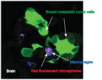 This image from IU School of Medicine researcher Susan Clare shows macrophages carrying nanoparticles (with a fluorescent dye attached) at the site of metastatic breast tumor cells in the brain.

Credit: Susan Clare, M.D., Ph.D.