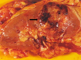 Nephrectomy specimen showing a renal cell carcinoma composed of a tumor mass with yellowish and hemorrhagic areas (arrow).