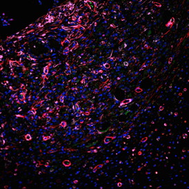 A microscopic image shows the extensive infiltration of robust blood vessels (red) in a new hydrogel scaffold developed at Rice University to help the healing of internal injuries. The purple cells are pericyte-like cells that surround new endothelial cells, helping to stabilize the vessels. The green cells are circulating through the new vascular system.
CREDIT: Vivek Kumar/Rice University