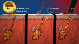 The particles are delivered into the sebaceous gland by the ultrasound, and are heated by the laser. The heat deactivates the gland.
CREDIT: Peter Allen Illustration