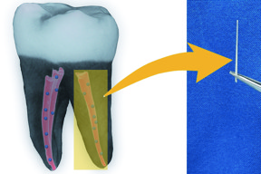 American Chemical Society/Dong-Keun Lee
A 3-D image of a tooth filled with nanodiamond-enhanced gutta percha, and an individual gutta percha point.