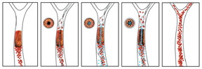 The novel drug-device combination developed by a team from the Wyss Institute at Harvard University and the New England Center for Stroke Research at University of Massachusetts works quickly to re-vascularize a vessel obstructed by a blood clot. In this schematic, the re-vascularization process is depicted from left to right. The intra-arterial stent is used to open a small channel in the blood clot, restoring enough blood flow to trigger the clot-busting nanotherapeutic which is activated by physical cues of fluid shear force. Credit: Wyss Institute at Harvard University/New England Center for Stroke Research at the University of Massachusetts