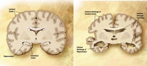 Figure 2: (L) A healthy brain (R) An AD affected brain.
CREDIT: IBS