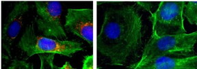 These are immunofluorescence images of cells (nuclei shown in blue; actin shown in green; BRAF shown in red). Left: control; right: after treatment with nanoparticles that silence BRAF.

Image courtesy of Jinjun Shi, Brigham and Women's Hospital