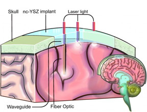 This is an illustration showing how the "Window to the Brain" transparent skull implant created by UC Riverside researchers would work.
CREDIT: UC Riverside