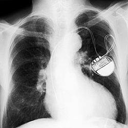 Pacemakers, like the implanted one shown in this image, are among the low-power devices that could be affected by new NIST findings about transistor noise. The findings indicate unforeseen problems could crop up as transistors grow smaller and run on less power, potentially impacting cell phones and laptops as well.

Credit: Shutterstock; copyright Dario Sabljak
