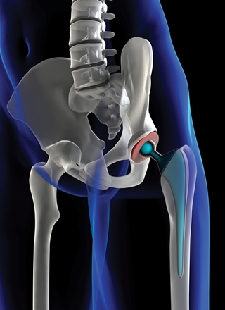 Self-healing polymers could provide biocompatible coatings for hip joints and other internal prostheses