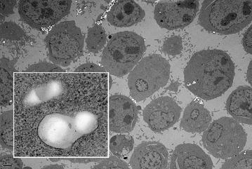 Images of Ramos cells targeted with nanoparticles. Particles carrying human transferrin (white dots, above image and close-up insert) were able to zero in on, attach to and enter cells (grey spheres). 