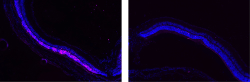 Image on left shows damage (pink) to the retina. Image on right show that POD GDNF nanoparticles protected the retina from damage. (Image courtesy of Rajendra Kumar-Singh, Tufts University School of Medicine)