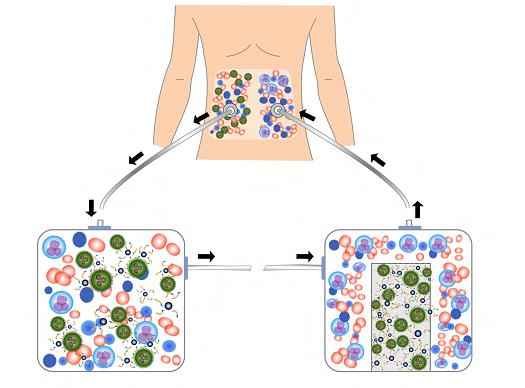 Schematic of magnetic nanoparticle treatment. Schematic shows how fluids containing ovarian cancer cells could be removed from the body, treated with magnetic nanoparticles to remove the cells, then returned to the body. (Courtesy of Ken Scarberry)