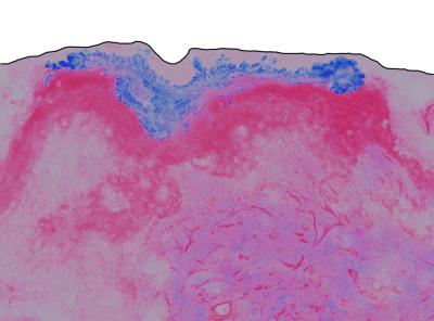 Zinc oxide (ZnO) nanoparticle distribution in excised human skin. The black line represents the surface of the skin (top), blue represents ZnO nanoparticle distribution in the skin (stratum corneum), and pink represents skin.

Credit: Timothy Kelf, Macquarie University.