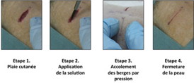 Phase 1 Skin injury, Phase 2 Application of the solution, Phase 3 Using pressure to hold the edges together, Phase 4 Skin closure. Illustration of the first experiment conducted by the researchers on rats: a deep wound is repaired by applying the aqueous nanoparticle solution. The wound closes in thirty seconds.  "Matire Molle et Chimie" Laboratory CNRS/ESPCI Paris Tech