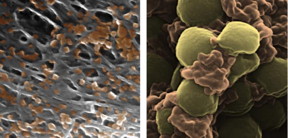 Pseudocolored scanning electron microscope images of platelet-membrane-coated nanoparticles (orange) binding to the lining of a damaged artery (left) and to MRSA bacteria (right). Each nanoparticle is approximately 100 nanometers in diameter, which is one thousand times thinner than an average sheet of paper.
CREDIT: Zhang Research Group, UC San Diego Jacobs School of Engineering.