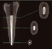 A new root canal filler containing nanodiamonds could help prevent re-infections. 
Credit: American Chemical Society 