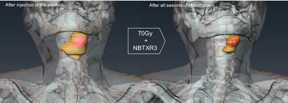 Figure: Patient treated with NBTXR3; 3D scan reconstruction before and after radiotherapy, showing tumor reduction and presence of the nanoparticles in the tumor with no leakage in surrounding healthy tissues. (In yellow Tumor. In pink NBTXR3).