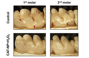 An iron oxide nanoparticle applied to teeth prior to treatment with hydrogen peroxide effectively reduced the onset and severity of cavities (indicated with red arrows) in rats.
CREDIT: University of Pennsylvania