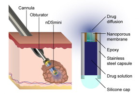 This diagram describes how the device Dr. Hood helped to develop is implanted into a cancerous tumor.
CREDIT
Lyle Hood/UTSA