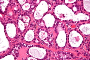 A high-magnification micrograph of an ovarian clear cell carcinoma. The images show, focally, the characteristic clear cells with prominent nucleoli and the typical hyaline globules. A high-magnification micrograph of an ovarian clear cell carcinoma. The images show, focally, the characteristic clear cells with prominent nucleoli and the typical hyaline globules.

Image: Nephron/CC BY-SA 3.0