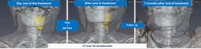 Illustration : 3D reconstruction of CT scan (tumor in yellow) patient treated at a 15% dose level showing a Complete Response 7 months after the end of the treatment.