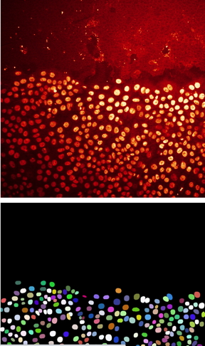 Example illustrating how AI via ZeroCostDL4Mic can be used to detect the nucleus of cancer cells from microscopy images. Upper picture: Original microscopy image. Lower picture: Image where each detected cancer cell has a different colour. Pictures: Guillaume Jacquemet.
