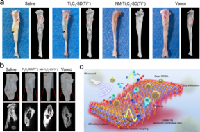 HKUMed invents a novel two-dimensional (2D) ultrasound-responsive antibacterial nano-sheets to effectively address bone tissue infection.

CREDIT
The University of Hong Kong
